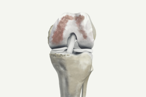 Tricompartmental Osteoarthritis